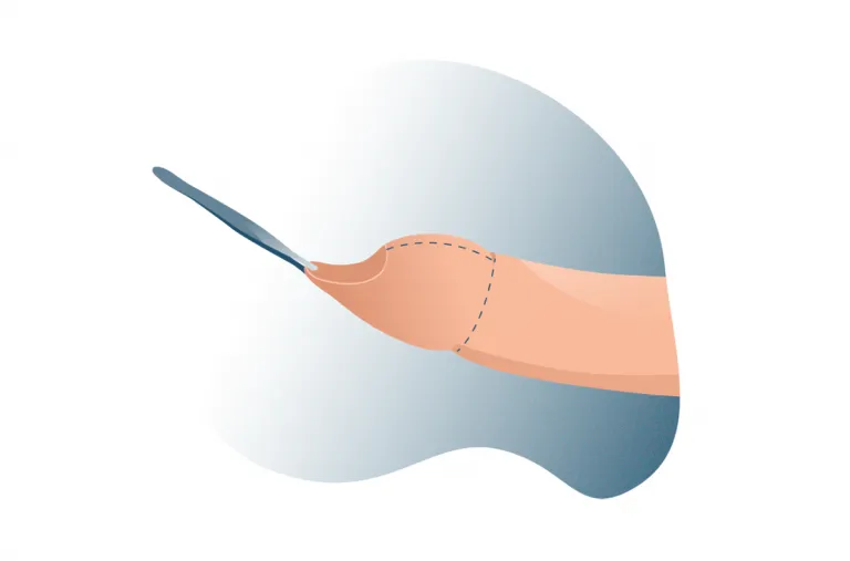 Ilustración representativa de fimosis