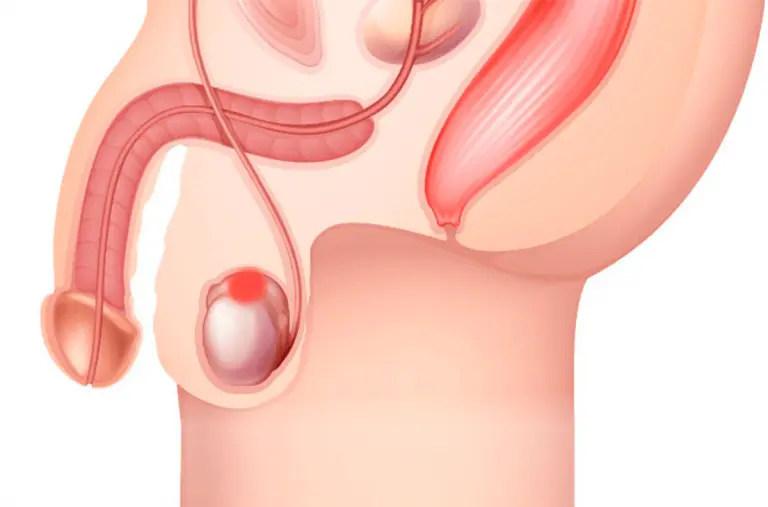 Ilustración representativa de quistes de epidídimo